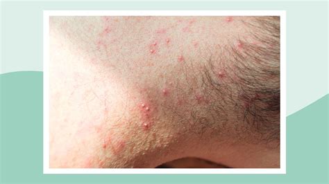 Armpit Rash: 14 Possible Causes and How to Treat Them .